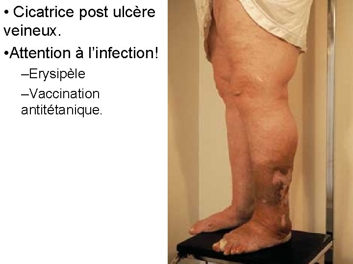  • Cicatrice post ulcère veineux. • Attention à l’infection! –Erysipèle –Vaccination antitétanique. 