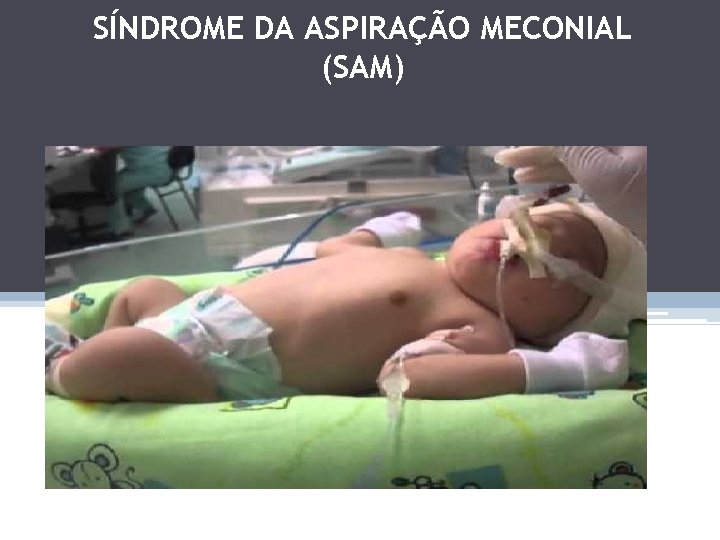 SÍNDROME DA ASPIRAÇÃO MECONIAL (SAM) 