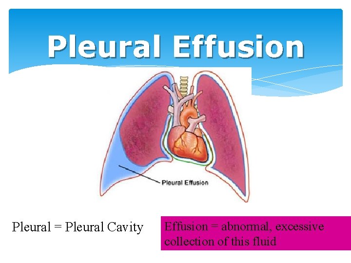 Pleural Effusion Pleural = Pleural Cavity Effusion = abnormal, excessive collection of this fluid