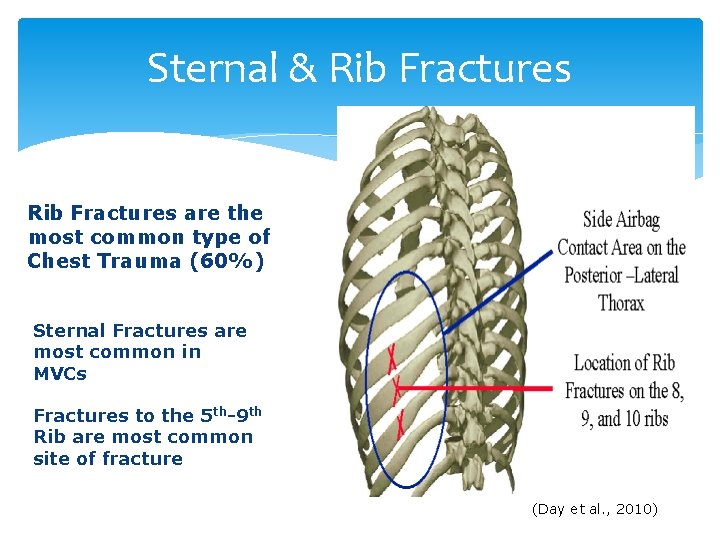 Sternal & Rib Fractures are the most common type of Chest Trauma (60%) Sternal