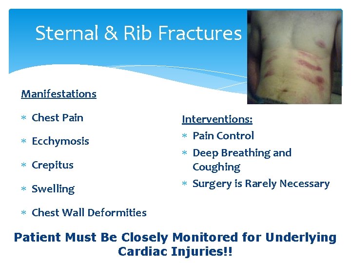 Sternal & Rib Fractures Manifestations Chest Pain Ecchymosis Crepitus Swelling Interventions: Pain Control Deep