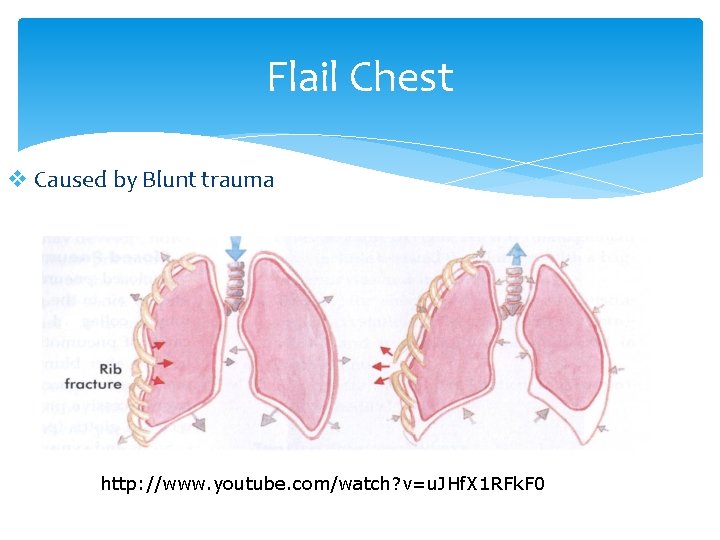 Flail Chest v Caused by Blunt trauma http: //www. youtube. com/watch? v=u. JHf. X