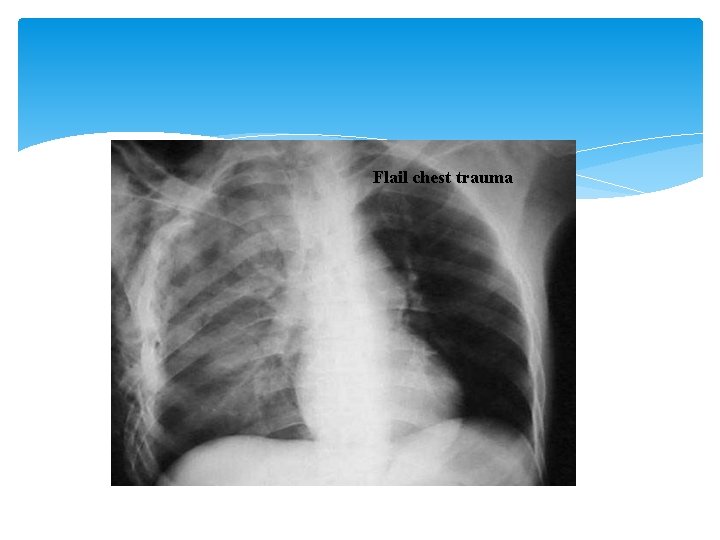 Flail chest trauma 