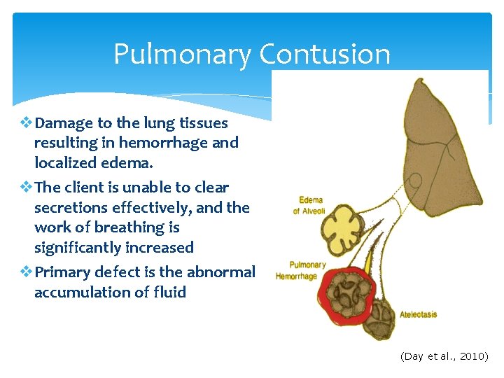 Pulmonary Contusion v. Damage to the lung tissues resulting in hemorrhage and localized edema.
