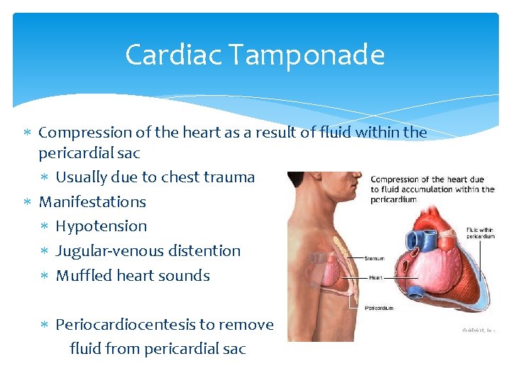 Cardiac Tamponade Compression of the heart as a result of fluid within the pericardial