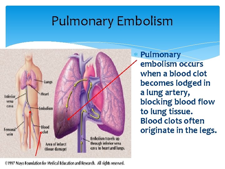 Pulmonary Embolism Pulmonary embolism occurs when a blood clot becomes lodged in a lung