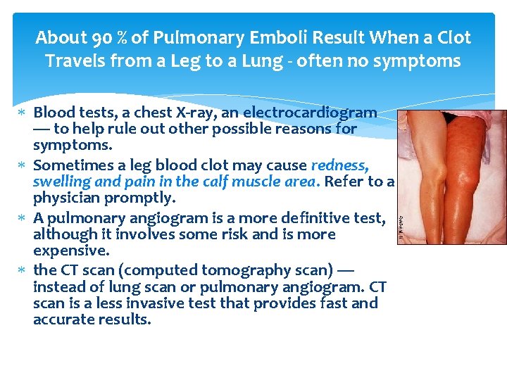About 90 % of Pulmonary Emboli Result When a Clot Travels from a Leg