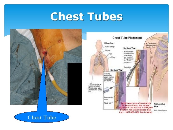 Chest Tubes Chest Tube 