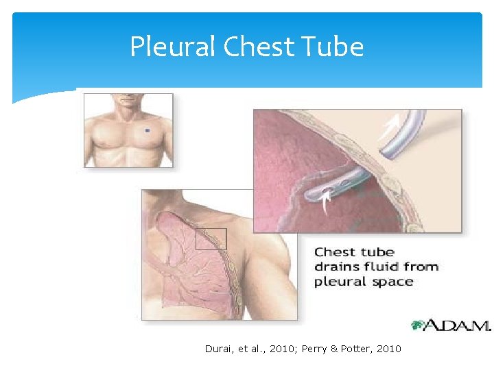 Pleural Chest Tube Durai, et al. , 2010; Perry & Potter, 2010 
