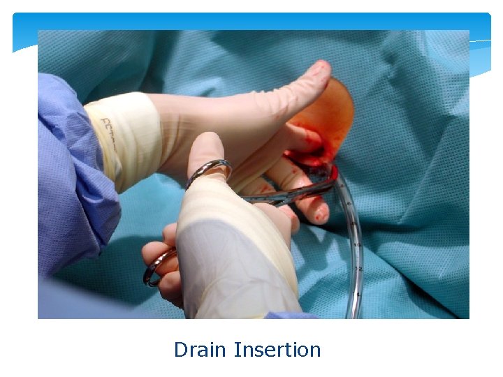 Drain Insertion 