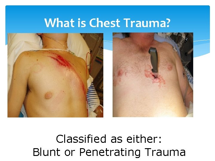 What is Chest Trauma? Classified as either: Blunt or Penetrating Trauma 
