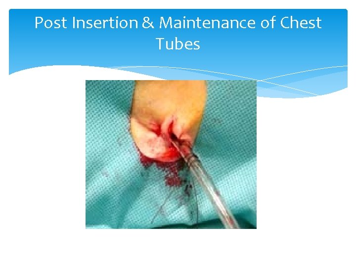 Post Insertion & Maintenance of Chest Tubes 