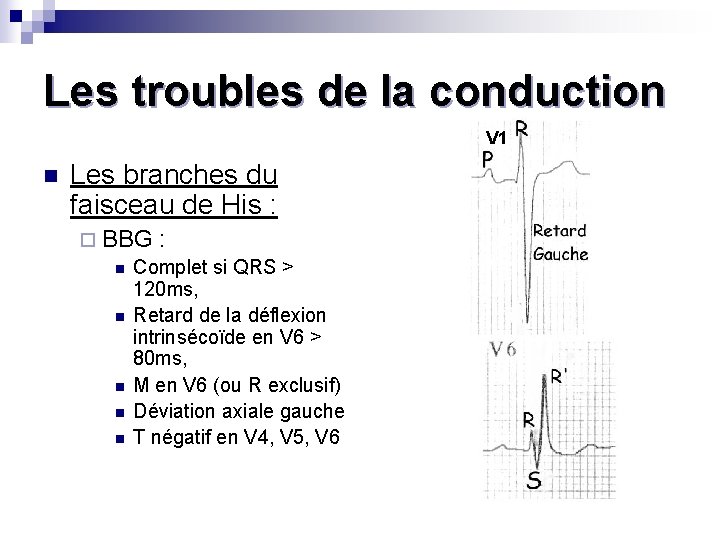 Les troubles de la conduction V 1 n Les branches du faisceau de His