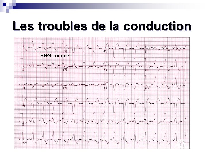 Les troubles de la conduction BBG complet 