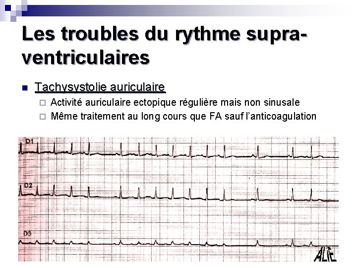 Les troubles du rythme supraventriculaires n Tachysystolie auriculaire Activité auriculaire ectopique régulière mais non