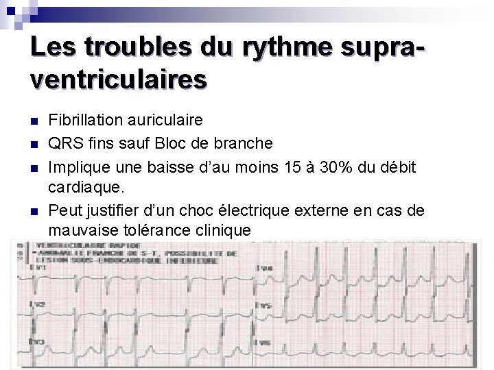 Les troubles du rythme supraventriculaires n n Fibrillation auriculaire QRS fins sauf Bloc de