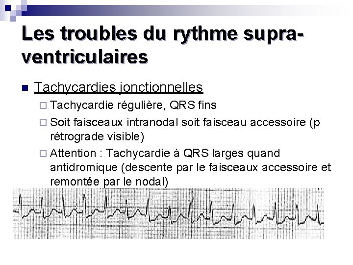 Les troubles du rythme supraventriculaires n Tachycardies jonctionnelles ¨ Tachycardie régulière, QRS fins ¨