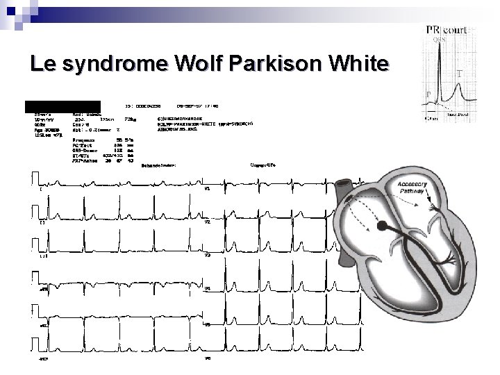 Le syndrome Wolf Parkison White 