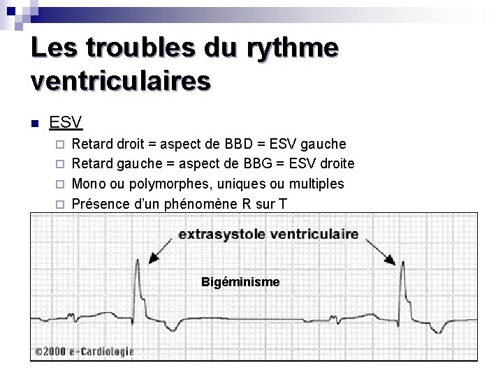 Les troubles du rythme ventriculaires n ESV Retard droit = aspect de BBD =