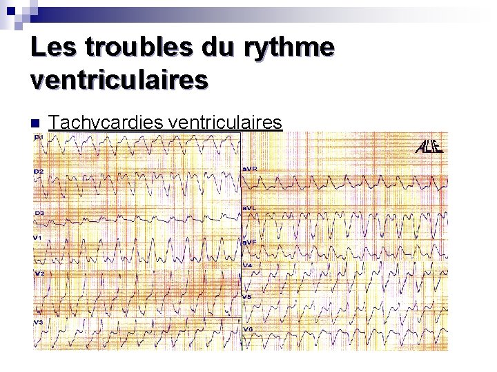 Les troubles du rythme ventriculaires n Tachycardies ventriculaires 