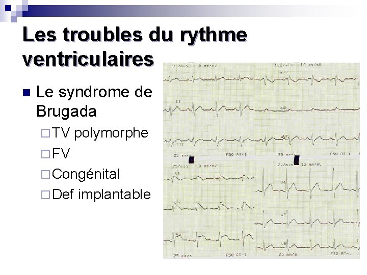 Les troubles du rythme ventriculaires n Le syndrome de Brugada ¨ TV polymorphe ¨