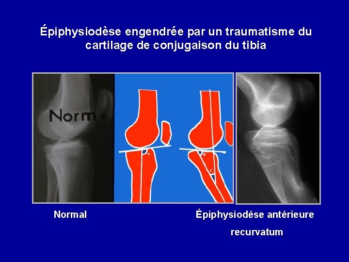 Épiphysiodèse engendrée par un traumatisme du cartilage de conjugaison du tibia Normal Épiphysiodèse antérieure