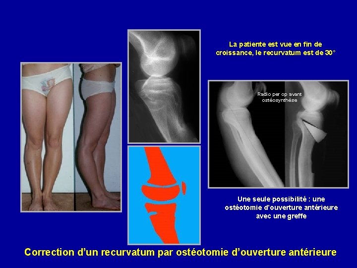 La patiente est vue en fin de croissance, le recurvatum est de 30° Radio