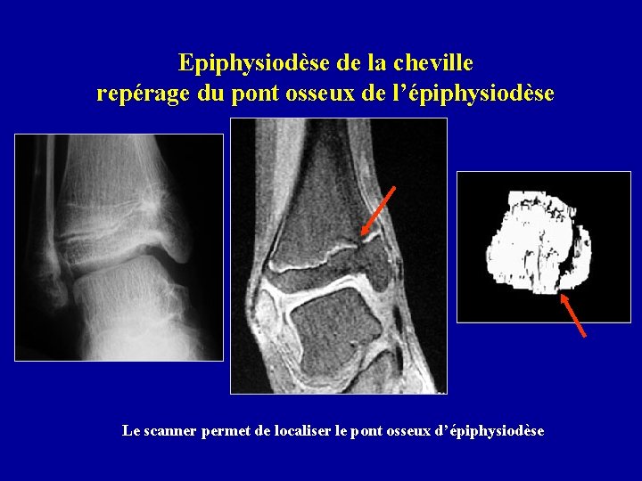 Epiphysiodèse de la cheville repérage du pont osseux de l’épiphysiodèse Le scanner permet de