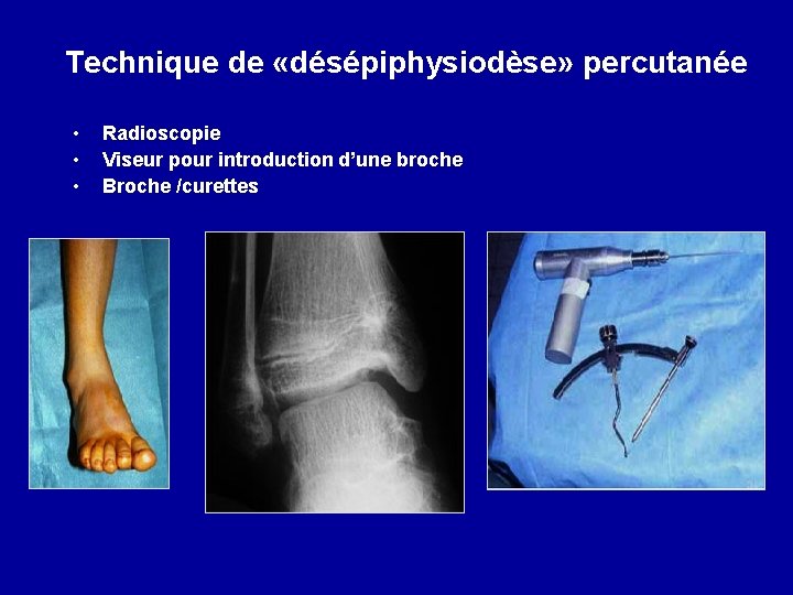 Technique de «désépiphysiodèse» percutanée • • • Radioscopie Viseur pour introduction d’une broche Broche