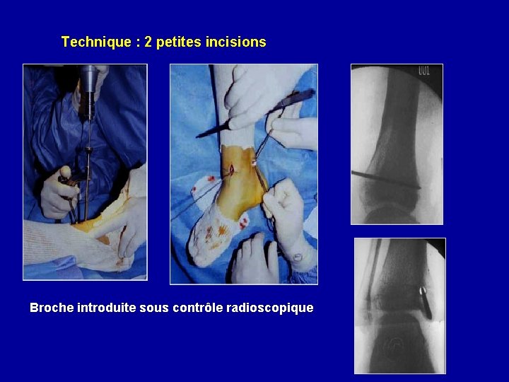 Technique : 2 petites incisions Broche introduite sous contrôle radioscopique 