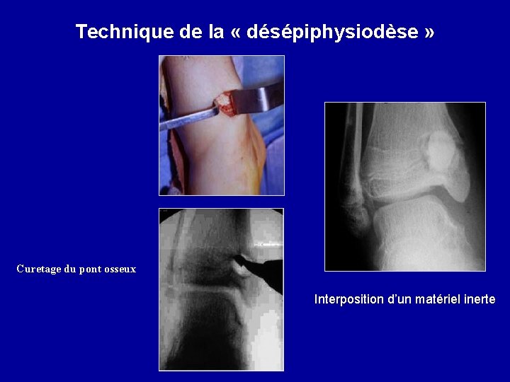 Technique de la « désépiphysiodèse » Curetage du pont osseux Interposition d’un matériel inerte