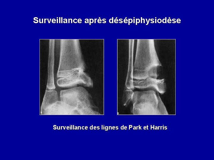 Surveillance après désépiphysiodèse Surveillance des lignes de Park et Harris 