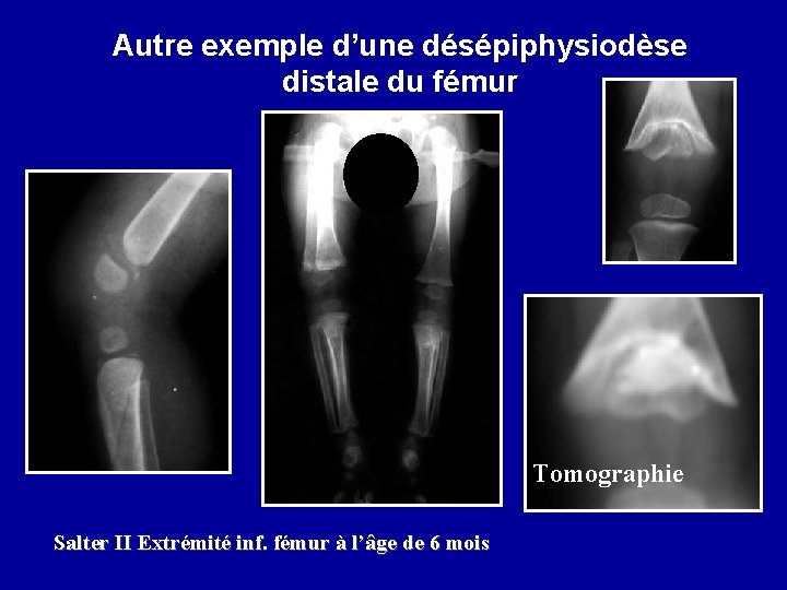 Autre exemple d’une désépiphysiodèse distale du fémur Tomographie Salter II Extrémité inf. fémur à