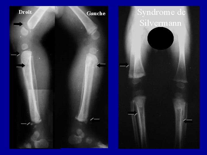 Droit Gauche Syndrome de Silvermann 