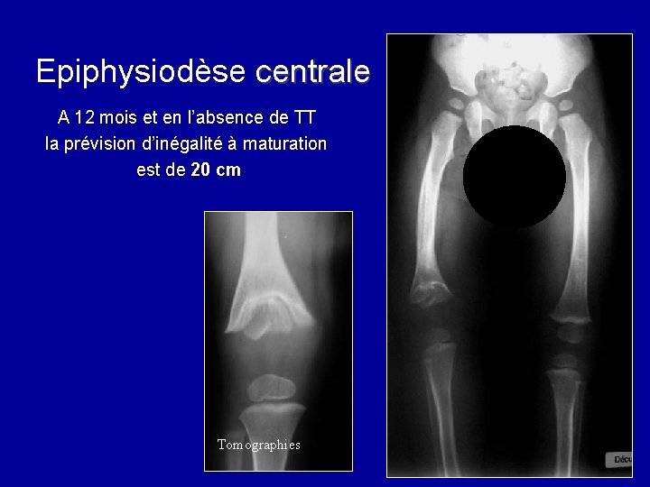 Epiphysiodèse centrale A 12 mois et en l’absence de TT la prévision d’inégalité à