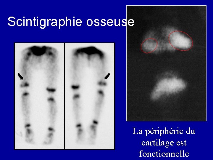 Scintigraphie osseuse La périphérie du cartilage est fonctionnelle 