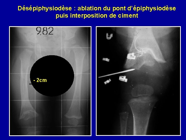 Désépiphysiodèse : ablation du pont d’épiphysiodèse puis interposition de ciment - 2 cm 