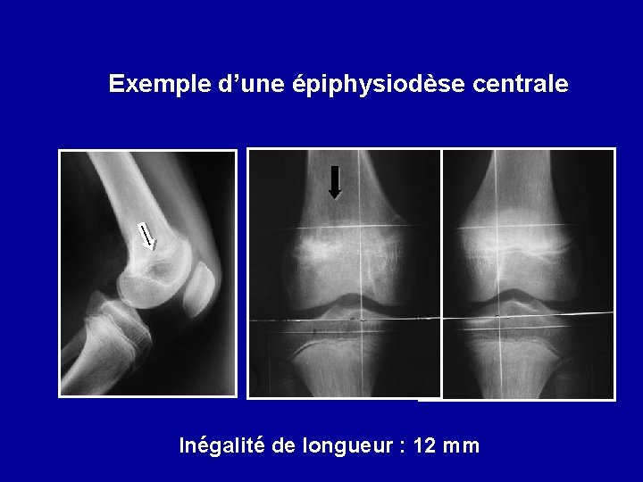 Exemple d’une épiphysiodèse centrale Inégalité de longueur : 12 mm 