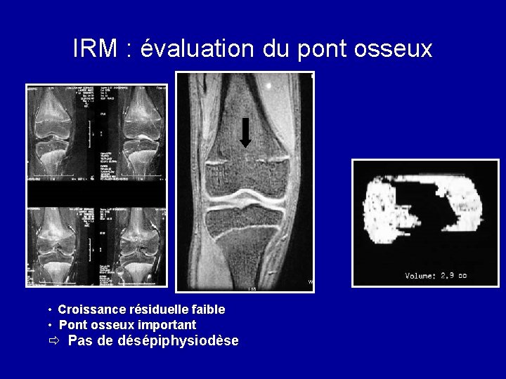 IRM : évaluation du pont osseux • Croissance résiduelle faible • Pont osseux important