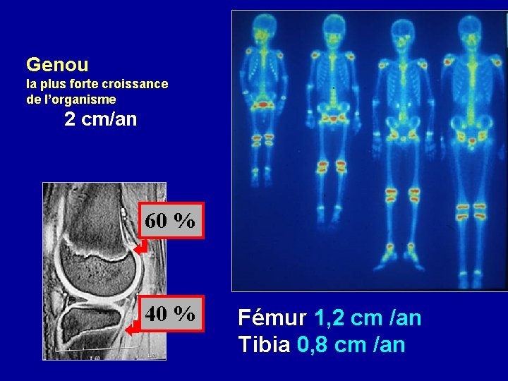 Genou la plus forte croissance de l’organisme 2 cm/an 60 % 40 % Fémur