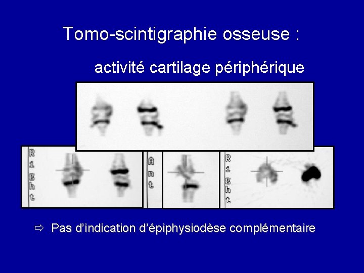 Tomo-scintigraphie osseuse : activité cartilage périphérique ð Pas d’indication d’épiphysiodèse complémentaire 