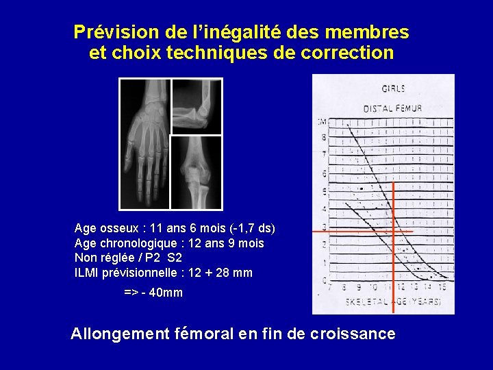 Prévision de l’inégalité des membres et choix techniques de correction Age osseux : 11