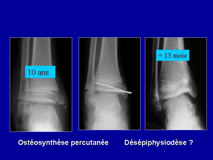 + 13 mois 10 ans Ostéosynthèse percutanée Désépiphysiodèse ? 