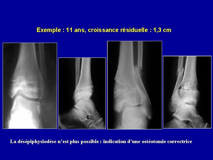 Exemple : 11 ans, croissance résiduelle : 1, 3 cm La désépiphysiodèse n’est plus