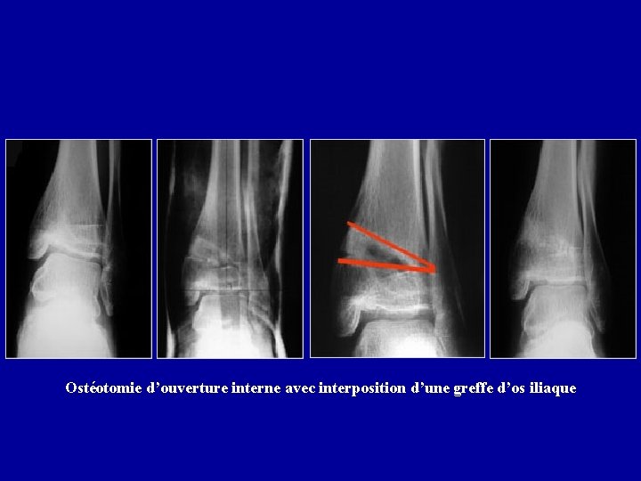 Ostéotomie d’ouverture interne avec interposition d’une greffe d’os iliaque 