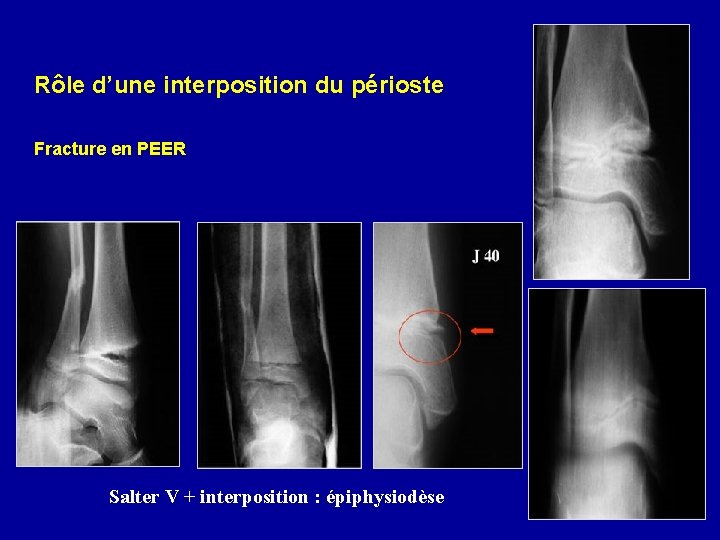 Rôle d’une interposition du périoste Fracture en PEER Salter V + interposition : épiphysiodèse