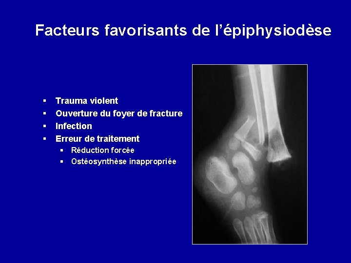 Facteurs favorisants de l’épiphysiodèse § § Trauma violent Ouverture du foyer de fracture Infection