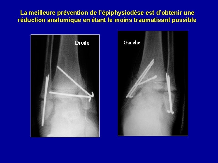 La meilleure prévention de l’épiphysiodèse est d’obtenir une réduction anatomique en étant le moins