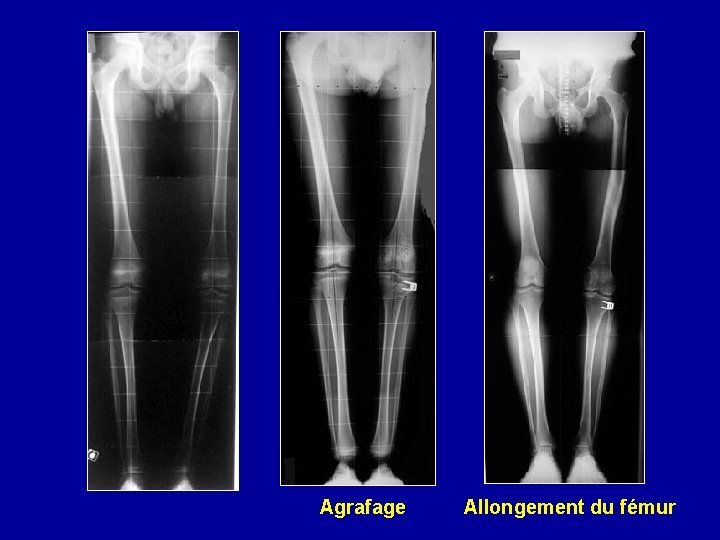 Agrafage Allongement du fémur 