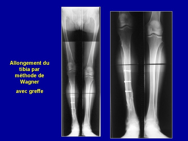 Allongement du tibia par méthode de Wagner avec greffe 